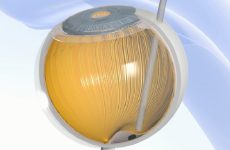 Implant PRIMA firmy Science Corporation przywraca funkcjonalne widzenie centralne osobom, które utraciły wzrok w wyniku AMD