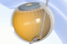 Implant PRIMA firmy Science Corporation przywraca funkcjonalne widzenie centralne osobom, które utraciły wzrok w wyniku AMD